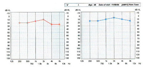 Φυσιολογικό Ακοόγραμμα. Στο διάγραμμα σημειώνεται η ελάχιστη ένταση σε decibel που μπορεί να ακούσει ο εξεταζόμενος σε κάθε συχνότητα. Για τον ενήλικα, τιμές μικρότερες από 25 dB θεωρούνται φυσιολογικές. Η κόκκινη καμπύλη αναφέρεται στο δεξί αυτί και η μπλε καμπύλη στο αριστερό.