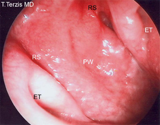 Εικόνα φυσιολογικού ρινοφάρυγγα στον ενήλικα (ενδοσκοπική εικόνα μέσα από τη μύτη): Φαίνονται τα στόμια της ευσταχιανής σάλπιγγας, που αερίζει το αυτί (ΕΤ). Τα κρεατάκια αναπτύσσονται στην περιοχή του οπισθίου τοιχώματος (PW), και μπορεί να επηρεάσουν και τη ρινική αναπνοή, αλλά και τις ευσταχιανές σάλπιγγες.