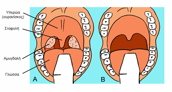 Φαρυγγοπλαστική: Α: Η επέμβαση έχει σαν σκοπό τη μείωση των μαλακών ιστών του φάρυγγα, που προκαλούν απόφραξη. Αφαιρούνται οι αμυγδαλές και μέρος της σταφυλής, ενώ με ειδικά σχεδιασμένες τομές στην υπερώα μειώνεται το δονούμενο τμήμα του φάρυγγα. Β: Μετά την επέμβαση, τα μαλακά μόρια του φάρυγγα έχουν πολύ μικρότερο όγκο.