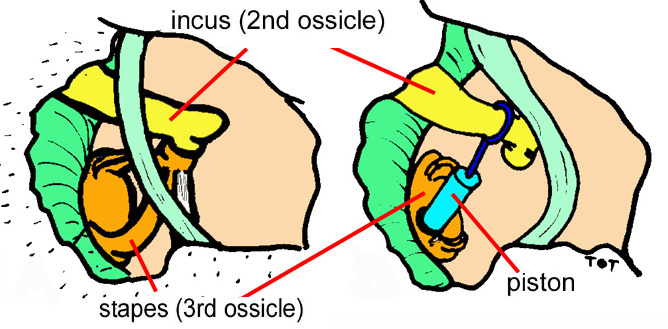 Stapedotomy for Otosclerosis. The superstructure of the third ossicle, the stapes, is removed, and a minute hole is opened in its base (the footplate). A small piston made of platinum and titanium is fitted in the hole and secured around the second ossicle in the chain, the incus.