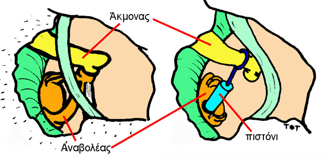 Σχηματική απεικόνιση της Αναβολοτομής για Ωτοσκλήρυνση. Αφαιρείται η υπερκατασκευή του αγκυλωμένου αναβολέα, που είναι το τρίτο και τελευταίο οστάριο στην αλυσίδα, ανοίγεται μία μικροσκοπική τρύπα στη βάση του (διαμέτρου περίπου 0,8 mm) και προσαρμόζεται ένα ειδικό πιστόνι από πλατίνα και τιτάνιο, το οποίο στερεώνεται στο δεύτερο οστάριο της αλυσίδας, τον άκμονα.