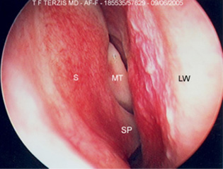 Nasal Septal Deviation as shown in the left nasal cavity: The nasal septum (S) forms a sharp spur (SP), which obstructs the left nasal cavity and inserts into the lateral nasal wall (LW).