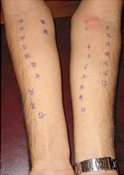 Negative Skin Prick Tests. Local reaction is present only at the position of the positive control (Νο1).