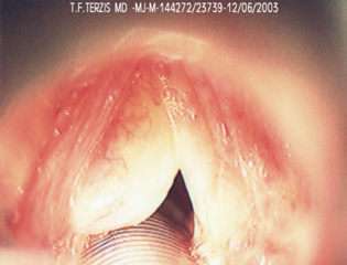 Polypoid degeneration of the vocal cords (Reinke’s oedema). The whole vocal cord is a large polyp. Voice is hoarse and low.