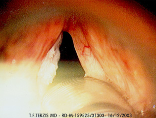 Leukoplakia of the larynx. The irregular white plate covers the whole surface of the left cord. Leukoplakia is a pre-malignant condition and is managed with care.